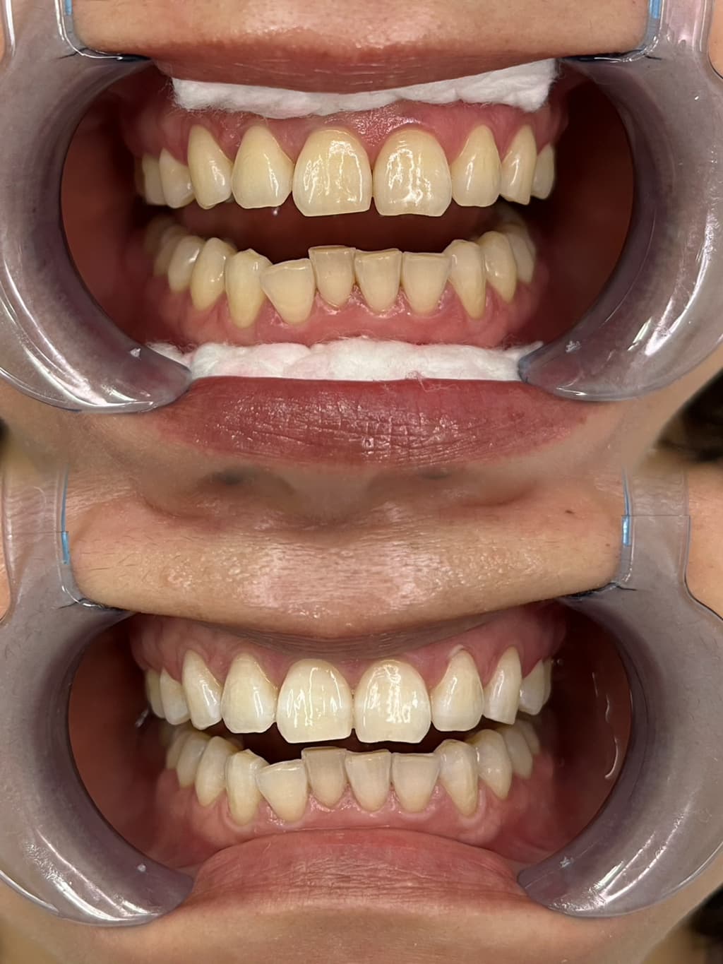 🦷치아미백서비스 사진 모델 WANTED 😁-이미지